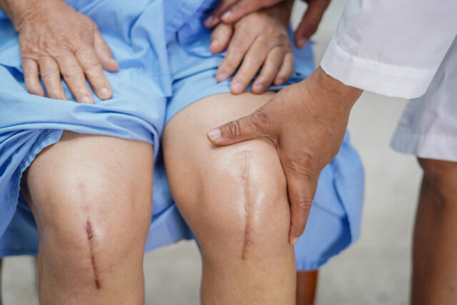 scars knees patient